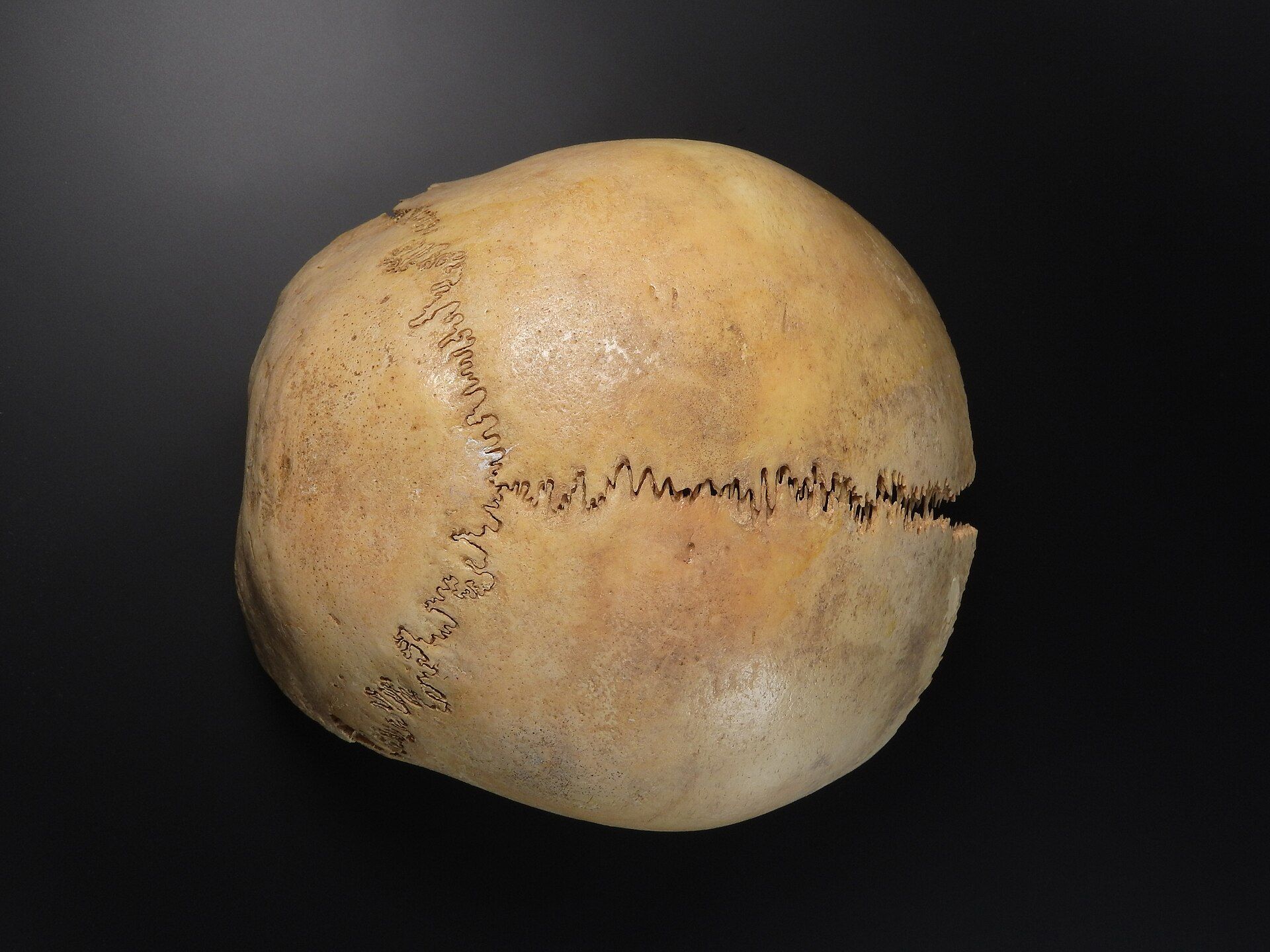 The top of a human skull seen from above, with a zigzag line running across it where two bones join