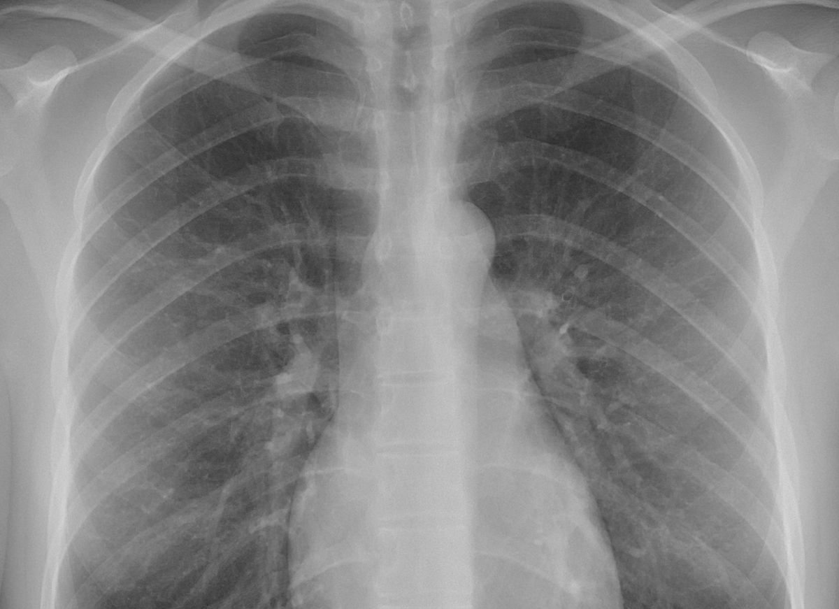 A chest X-ray: the ribs, collarbones and spine show up pale against the dark lungs