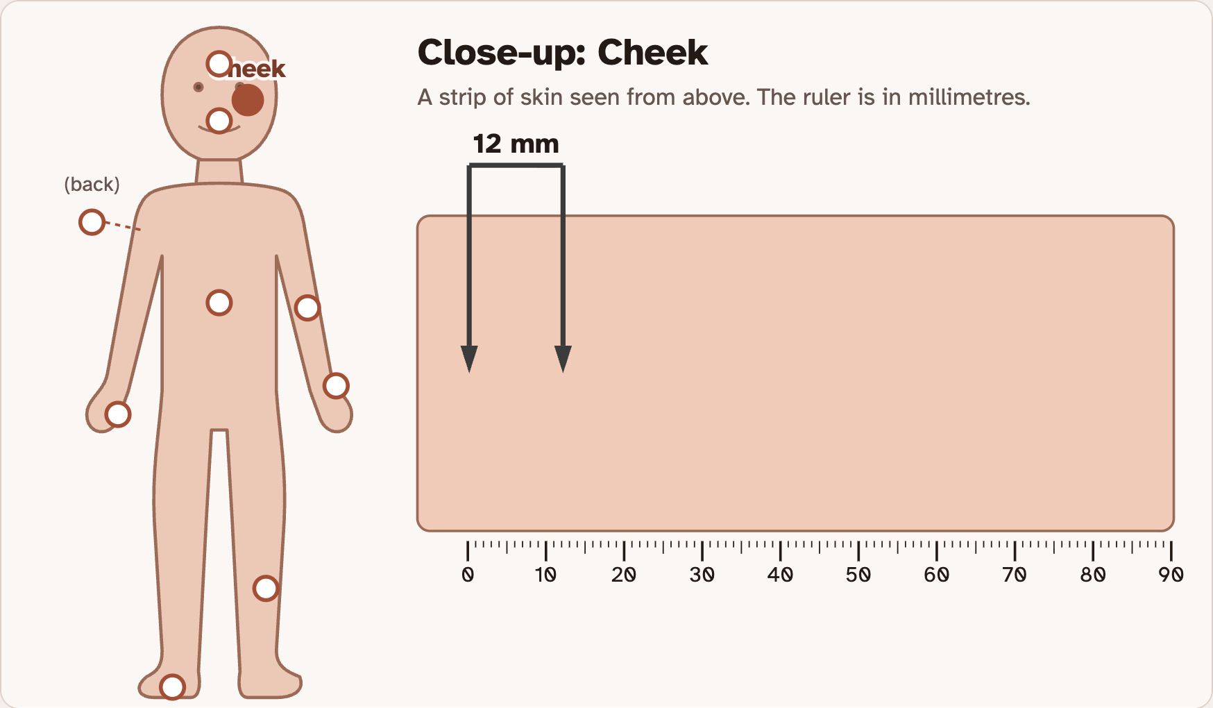 A drawing of a body with test sites marked, beside a close-up strip of cheek skin with two points 12 mm apart